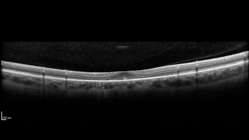 Plaquenil Toxicity - 4 years use
47 year old female She started plaquenil 4 years ago for lupus with cutaneous findings.  She has never been on the plaquenil before.  Her renal function is normal (her husband is an internist) and she is not on Tamoxifen.  Stopped the medication about 2.5 weeks ago.  She noticed vision when she started the depacote.  She is also myopic. (-9.50)  

Her dose was 6.3 mg/kg.  She is 5'1