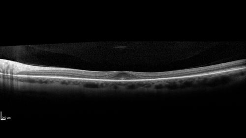 Plaquenil Toxicity - 4 years use
47 year old female She started plaquenil 4 years ago for lupus with cutaneous findings.  She has never been on the plaquenil before.  Her renal function is normal (her husband is an internist) and she is not on Tamoxifen.  Stopped the medication about 2.5 weeks ago.  She noticed vision when she started the depacote.  She is also myopic. (-9.50)  

Her dose was 6.3 mg/kg.  She is 5'1