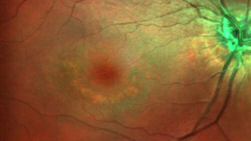 Hydroxychloroquine (plaquenil) Toxicity - Advanced
78 year old female No visual complaints referred for evaluation
Medical Hx: Rheumatoid Arthritis. Atrial Fibrillation. Benign Intracranial Hypertension. Sjogrens Syndrome. Osteoporosis. 
Systemic Meds: PLAQUENIL (Stopped 2 months ago). Leflunomide. Lidocaine. Gabapentin. Vitamin D. Multaq. DILTIAZEM.
VA OD: Dcc20/32-2 NccJ2
VA OS: Dcc20/25+1 NccJ1-1
IOP: TP: OD:14 OS:15 
Color Ishihara OD 9/11 correct, OS 9.5/11 correct
Weight 100 lbs, Height 4â€™ 2â€ tall.
1993 Plaquenil Initially 400 mg /day (9 mg/kg/day x 18 years) then 2011 200 mg daily - (4.6 mg/kg/day x 10 years) STOPPED 3/2021
The patient weighs 100 lbs and is 4â€™ 2â€ tall - Images are from 3/2021 and 5/2022
There was no progression 1 year after stopping plaquenil in this patient.
