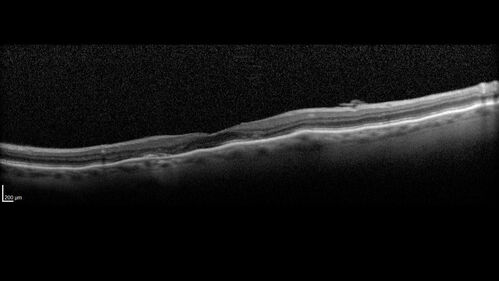 Hydroxychloroquine (plaquenil) Toxicity - Advanced
78 year old female No visual complaints referred for evaluation
Medical Hx: Rheumatoid Arthritis. Atrial Fibrillation. Benign Intracranial Hypertension. Sjogrens Syndrome. Osteoporosis. 
Systemic Meds: PLAQUENIL (Stopped 2 months ago). Leflunomide. Lidocaine. Gabapentin. Vitamin D. Multaq. DILTIAZEM.
VA OD: Dcc20/32-2 NccJ2
VA OS: Dcc20/25+1 NccJ1-1
IOP: TP: OD:14 OS:15 
Color Ishihara OD 9/11 correct, OS 9.5/11 correct
Weight 100 lbs, Height 4â€™ 2â€ tall.
1993 Plaquenil Initially 400 mg /day (9 mg/kg/day x 18 years) then 2011 200 mg daily - (4.6 mg/kg/day x 10 years) STOPPED 3/2021
The patient weighs 100 lbs and is 4â€™ 2â€ tall - Images are from 3/2021 and 5/2022
There was no progression 1 year after stopping plaquenil in this patient.
