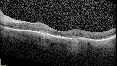 Hydroxychloroquine (plaquenil) Toxicity - Advanced
78 year old female No visual complaints referred for evaluation
Medical Hx: Rheumatoid Arthritis. Atrial Fibrillation. Benign Intracranial Hypertension. Sjogrens Syndrome. Osteoporosis. 
Systemic Meds: PLAQUENIL (Stopped 2 months ago). Leflunomide. Lidocaine. Gabapentin. Vitamin D. Multaq. DILTIAZEM.
VA OD: Dcc20/32-2 NccJ2
VA OS: Dcc20/25+1 NccJ1-1
IOP: TP: OD:14 OS:15 
Color Ishihara OD 9/11 correct, OS 9.5/11 correct
Weight 100 lbs, Height 4â€™ 2â€ tall.
1993 Plaquenil Initially 400 mg /day (9 mg/kg/day x 18 years) then 2011 200 mg daily - (4.6 mg/kg/day x 10 years) STOPPED 3/2021
The patient weighs 100 lbs and is 4â€™ 2â€ tall - Images are from 3/2021 and 5/2022
There was no progression 1 year after stopping plaquenil in this patient.
