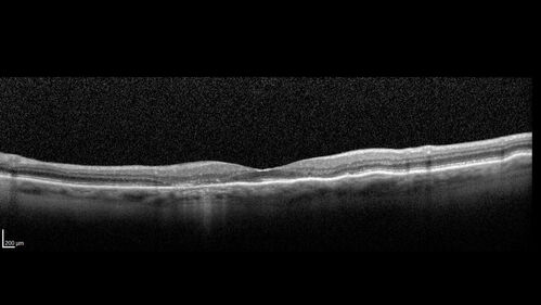 Hydroxychloroquine (plaquenil) Toxicity - Advanced
78 year old female No visual complaints referred for evaluation
Medical Hx: Rheumatoid Arthritis. Atrial Fibrillation. Benign Intracranial Hypertension. Sjogrens Syndrome. Osteoporosis. 
Systemic Meds: PLAQUENIL (Stopped 2 months ago). Leflunomide. Lidocaine. Gabapentin. Vitamin D. Multaq. DILTIAZEM.
VA OD: Dcc20/32-2 NccJ2
VA OS: Dcc20/25+1 NccJ1-1
IOP: TP: OD:14 OS:15 
Color Ishihara OD 9/11 correct, OS 9.5/11 correct
Weight 100 lbs, Height 4â€™ 2â€ tall.
1993 Plaquenil Initially 400 mg /day (9 mg/kg/day x 18 years) then 2011 200 mg daily - (4.6 mg/kg/day x 10 years) STOPPED 3/2021
The patient weighs 100 lbs and is 4â€™ 2â€ tall - Images are from 3/2021 and 5/2022
There was no progression 1 year after stopping plaquenil in this patient.
