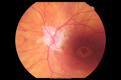 Plaquenil Toxicity - Bulls Eye Maculopathy
70-year-old woman with systemic Lupus erythematosus and clotting problems.  She was on the Plaquenil for about eight years and then off the Plaquenil for the last eight years because she developed macular toxicity.  Although her vision was hazy, it was stable. Recent deceased vision left eye: OD 20/60, OS 20/100.  IOP:  OD 18, OS 19.

Mots-clés: plaquenil;toxic retinopathy;toxic maculopathy;bulls eye;