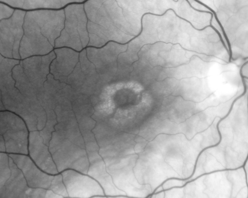 Plaquenil Toxicity - Bulls Eye Maculopathy
70-year-old woman with systemic Lupus erythematosus and clotting problems.  She was on the Plaquenil for about eight years and then off the Plaquenil for the last eight years because she developed macular toxicity.  Although her vision was hazy, it was stable. Recent deceased vision left eye: OD 20/60, OS 20/100.  IOP:  OD 18, OS 19.

Keywords: plaquenil;toxic retinopathy;toxic maculopathy;bulls eye;