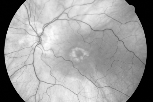 Plaquenil Toxicity - Bulls Eye Maculopathy
70-year-old woman with systemic Lupus erythematosus and clotting problems.  She was on the Plaquenil for about eight years and then off the Plaquenil for the last eight years because she developed macular toxicity.  Although her vision was hazy, it was stable. Recent deceased vision left eye: OD 20/60, OS 20/100.  IOP:  OD 18, OS 19.

Keywords: plaquenil;toxic retinopathy;toxic maculopathy;bulls eye;