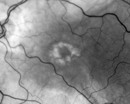 Plaquenil Toxicity - Bulls Eye Maculopathy
70-year-old woman with systemic Lupus erythematosus and clotting problems.  She was on the Plaquenil for about eight years and then off the Plaquenil for the last eight years because she developed macular toxicity.  Although her vision was hazy, it was stable. Recent deceased vision left eye: OD 20/60, OS 20/100.  IOP:  OD 18, OS 19.

Keywords: plaquenil;toxic retinopathy;toxic maculopathy;bulls eye;