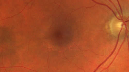 Hydroxychloroquine retinopathy - Plaquenil - Moderate
51 year old female on with trouble driving at  night for a year.  No eye examination for several years. 2009 (11 years ago) Plaquenil 300 then up to 400 a few years ago now down to 300 - 5'2" 135 lbs

VA 20/20 OD, 20/25 OS
