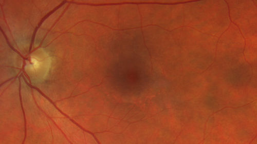 Hydroxychloroquine retinopathy - Plaquenil - Moderate
51 year old female on with trouble driving at  night for a year.  No eye examination for several years. 2009 (11 years ago) Plaquenil 300 then up to 400 a few years ago now down to 300 - 5'2" 135 lbs

VA 20/20 OD, 20/25 OS
