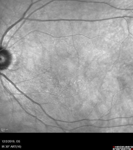 Hydroxychloroquine retinopathy - Plaquenil - Moderate
51 year old female on with trouble driving at  night for a year.  No eye examination for several years. 2009 (11 years ago) Plaquenil 300 then up to 400 a few years ago now down to 300 - 5'2" 135 lbs

VA 20/20 OD, 20/25 OS
