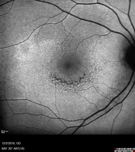 Hydroxychloroquine retinopathy - Plaquenil - Moderate
51 year old female on with trouble driving at  night for a year.  No eye examination for several years. 2009 (11 years ago) Plaquenil 300 then up to 400 a few years ago now down to 300 - 5'2" 135 lbs

VA 20/20 OD, 20/25 OS
