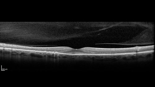 Hydroxychloroquine retinopathy - Plaquenil - Moderate
51 year old female on with trouble driving at  night for a year.  No eye examination for several years. 2009 (11 years ago) Plaquenil 300 then up to 400 a few years ago now down to 300 - 5'2" 135 lbs

VA 20/20 OD, 20/25 OS
