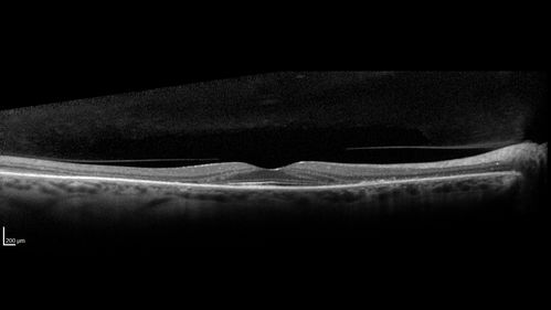 Hydroxychloroquine retinopathy - Plaquenil - Moderate
51 year old female on with trouble driving at  night for a year.  No eye examination for several years. 2009 (11 years ago) Plaquenil 300 then up to 400 a few years ago now down to 300 - 5'2" 135 lbs

VA 20/20 OD, 20/25 OS
