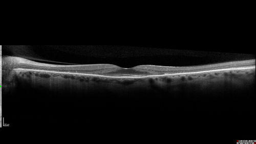 Hydroxychloroquine retinopathy - Plaquenil - Moderate
51 year old female on with trouble driving at  night for a year.  No eye examination for several years. 2009 (11 years ago) Plaquenil 300 then up to 400 a few years ago now down to 300 - 5'2" 135 lbs

VA 20/20 OD, 20/25 OS
