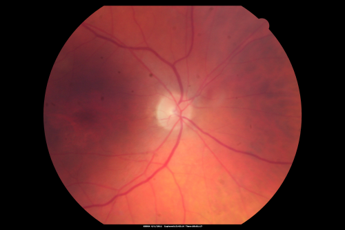 Plaquenil (Hydroxycholorquine) Toxicity - Bull's Eye Maculopathy - 73 year old womand 25 Years therapy - 64 inches tall - 110 lbs
73-year-old woman has been on Plaquenil for twenty five years.  She noticed loss of paracentral vision a few months ago. VISUAL ACUITY:  OD 20/70,  OS 20/30.   Her color vision was 0 out 10 correct in both eyes and she also missed the controls. 
