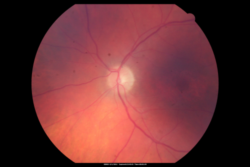 Plaquenil (Hydroxycholorquine) Toxicity - Bull's Eye Maculopathy - 73 year old womand 25 Years therapy - 64 inches tall - 110 lbs
73-year-old woman has been on Plaquenil for twenty five years.  She noticed loss of paracentral vision a few months ago. VISUAL ACUITY:  OD 20/70,  OS 20/30.   Her color vision was 0 out 10 correct in both eyes and she also missed the controls. 
