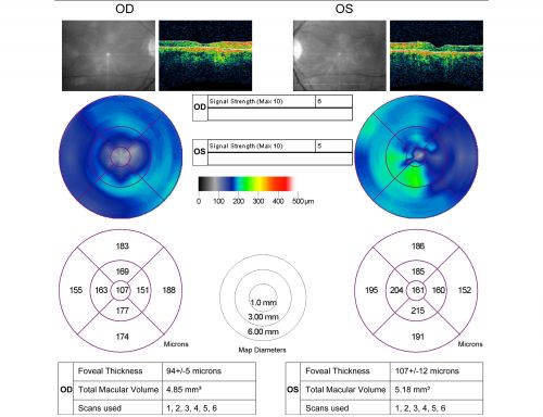 Plaquenil (Hydroxycholorquine) Toxicity - Bull's Eye Maculopathy - 73 year old womand 25 Years therapy - 64 inches tall - 110 lbs
73-year-old woman has been on Plaquenil for twenty five years.  She noticed loss of paracentral vision a few months ago. VISUAL ACUITY:  OD 20/70,  OS 20/30.   Her color vision was 0 out 10 correct in both eyes and she also missed the controls. 
