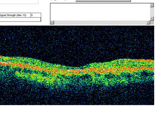 Plaquenil (Hydroxycholorquine) Toxicity - Bull's Eye Maculopathy - 73 year old womand 25 Years therapy - 64 inches tall - 110 lbs
73-year-old woman has been on Plaquenil for twenty five years.  She noticed loss of paracentral vision a few months ago. VISUAL ACUITY:  OD 20/70,  OS 20/30.   Her color vision was 0 out 10 correct in both eyes and she also missed the controls. 
