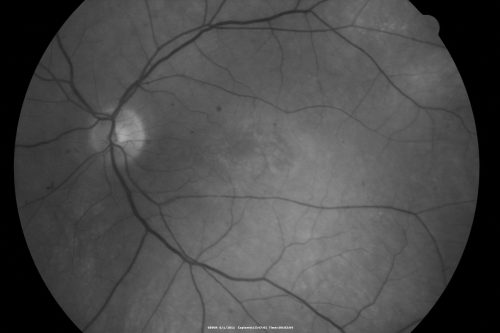 Plaquenil (Hydroxycholorquine) Toxicity - Bull's Eye Maculopathy - 73 year old womand 25 Years therapy - 64 inches tall - 110 lbs
73-year-old woman has been on Plaquenil for twenty five years.  She noticed loss of paracentral vision a few months ago. VISUAL ACUITY:  OD 20/70,  OS 20/30.   Her color vision was 0 out 10 correct in both eyes and she also missed the controls. 
