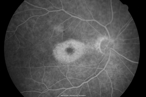 Plaquenil (Hydroxycholorquine) Toxicity - Bull's Eye Maculopathy - 73 year old womand 25 Years therapy - 64 inches tall - 110 lbs
73-year-old woman has been on Plaquenil for twenty five years.  She noticed loss of paracentral vision a few months ago. VISUAL ACUITY:  OD 20/70,  OS 20/30.   Her color vision was 0 out 10 correct in both eyes and she also missed the controls. 
