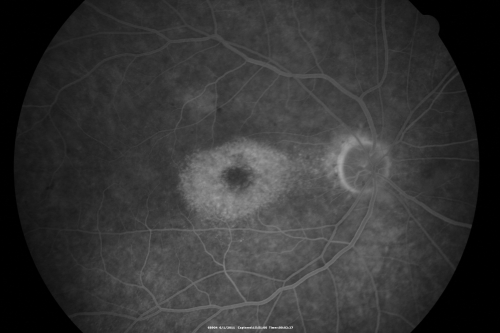 Plaquenil (Hydroxycholorquine) Toxicity - Bull's Eye Maculopathy - 73 year old womand 25 Years therapy - 64 inches tall - 110 lbs
73-year-old woman has been on Plaquenil for twenty five years.  She noticed loss of paracentral vision a few months ago. VISUAL ACUITY:  OD 20/70,  OS 20/30.   Her color vision was 0 out 10 correct in both eyes and she also missed the controls. 
