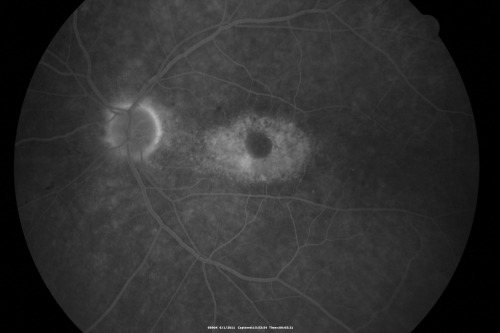 Plaquenil (Hydroxycholorquine) Toxicity - Bull's Eye Maculopathy - 73 year old womand 25 Years therapy - 64 inches tall - 110 lbs
73-year-old woman has been on Plaquenil for twenty five years.  She noticed loss of paracentral vision a few months ago. VISUAL ACUITY:  OD 20/70,  OS 20/30.   Her color vision was 0 out 10 correct in both eyes and she also missed the controls. 
