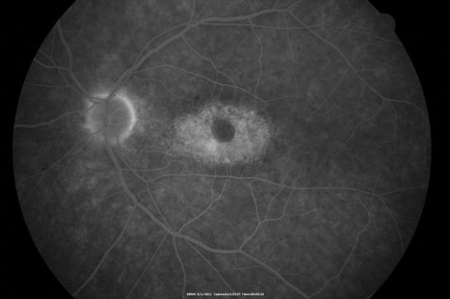 Plaquenil (Hydroxycholorquine) Toxicity - Bull's Eye Maculopathy - 73 year old womand 25 Years therapy - 64 inches tall - 110 lbs
73-year-old woman has been on Plaquenil for twenty five years.  She noticed loss of paracentral vision a few months ago. VISUAL ACUITY:  OD 20/70,  OS 20/30.   Her color vision was 0 out 10 correct in both eyes and she also missed the controls. 
