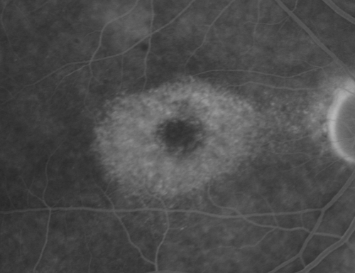 Plaquenil (Hydroxycholorquine) Toxicity - Bull's Eye Maculopathy - 73 year old womand 25 Years therapy - 64 inches tall - 110 lbs
73-year-old woman has been on Plaquenil for twenty five years.  She noticed loss of paracentral vision a few months ago. VISUAL ACUITY:  OD 20/70,  OS 20/30.   Her color vision was 0 out 10 correct in both eyes and she also missed the controls. 
