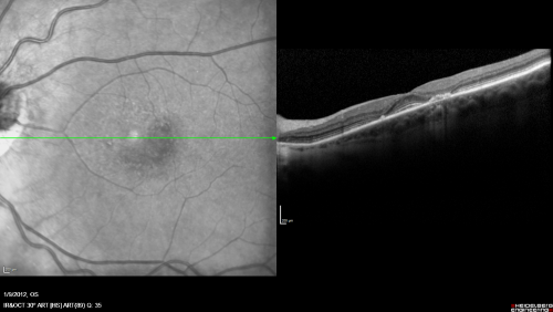 Plaquenil Toxicity both Eyes - Partial Bull's Eye - Discontinued 6 Years ago SD-OCT (Spectral domain optical coherence tomography)
82-year-old woman was on Plaquenil from 1976 from 2005, 200 mg a day.  It was discontinued because of abnormal visual fields 6 years ago. OD 20/32,  OS 20/40
