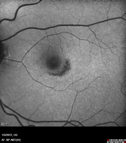 Plaquenil Toxicity both Eyes - Partial Bull's Eye - Discontinued 6 Years ago Fundus Autofluorescence
82-year-old woman was on Plaquenil from 1976 from 2005, 200 mg a day.  It was discontinued because of abnormal visual fields 6 years ago. OD 20/32,  OS 20/40
