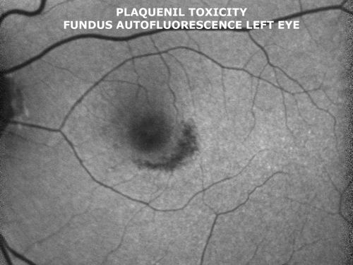 Plaquenil Toxicity both Eyes - Partial Bull's Eye - Discontinued 6 Years ago Fundus Autofluorescence
82-year-old woman was on Plaquenil from 1976 from 2005, 200 mg a day.  It was discontinued because of abnormal visual fields 6 years ago. OD 20/32,  OS 20/40
