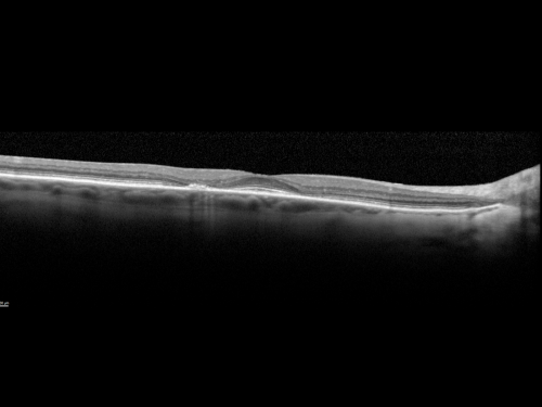 Plaquenil Toxicity both Eyes - Partial Bull's Eye - Discontinued 6 Years ago SD-OCT (Spectral domain optical coherence tomography)
82-year-old woman was on Plaquenil from 1976 from 2005, 200 mg a day.  It was discontinued because of abnormal visual fields 6 years ago. OD 20/32,  OS 20/40
