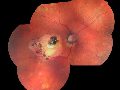 Macular Scars - Laser (1980s) Ocular Histoplasmosis
70 year old man who had laser at Wills, Wilmer and the Mayo clinic before better therapies were available for ocular histoplasmosis related CNVM
