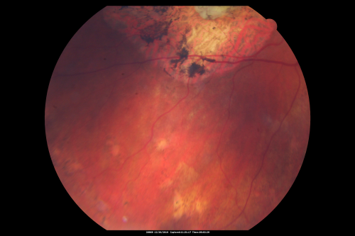 Macular Scars - Laser (1980s) Ocular Histoplasmosis
70 year old man who had laser at Wills, Wilmer and the Mayo clinic before better therapies were available for ocular histoplasmosis related CNVM

