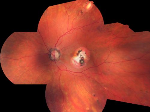 Macular Scars - Laser (1980s) Ocular Histoplasmosis
70 year old man who had laser at Wills, Wilmer and the Mayo clinic before better therapies were available for ocular histoplasmosis related CNVM

