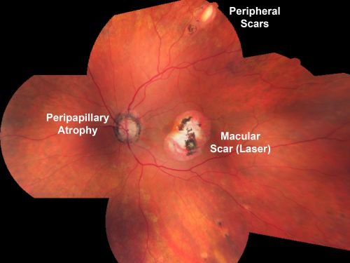 Macular Scars - Laser (1980s) Ocular Histoplasmosis
70 year old man who had laser at Wills, Wilmer and the Mayo clinic before better therapies were available for ocular histoplasmosis related CNVM
