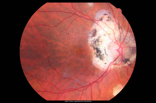 Ocular Histoplasmosis both Eyes - Laser Right Eye Only 
58-year-old woman who lost vision as a child in the left eye from ocular histoplasmosis.  She used to play in her attic and she was told by her pulmonary doctor that is probably where she picked it up.  She had laser in the right eye for a leaky lesion back in 1990.  OD 20/25,  OS 20/200. 
