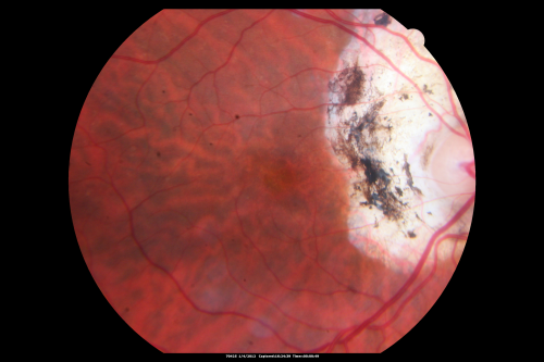Ocular Histoplasmosis both Eyes - Laser Right Eye Only 
58-year-old woman who lost vision as a child in the left eye from ocular histoplasmosis.  She used to play in her attic and she was told by her pulmonary doctor that is probably where she picked it up.  She had laser in the right eye for a leaky lesion back in 1990.  OD 20/25,  OS 20/200. 
