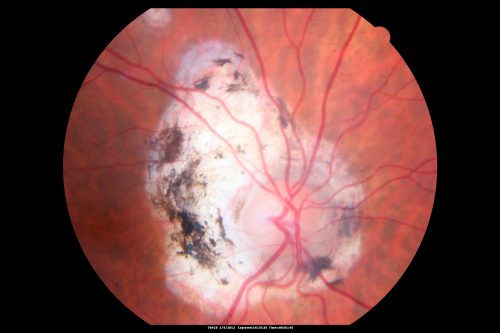 Ocular Histoplasmosis both Eyes - Laser Right Eye Only 
58-year-old woman who lost vision as a child in the left eye from ocular histoplasmosis.  She used to play in her attic and she was told by her pulmonary doctor that is probably where she picked it up.  She had laser in the right eye for a leaky lesion back in 1990.  OD 20/25,  OS 20/200. 

