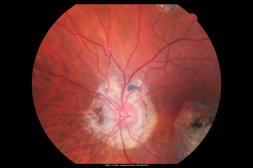 Ocular Histoplasmosis both Eyes - Laser Right Eye Only 
58-year-old woman who lost vision as a child in the left eye from ocular histoplasmosis.  She used to play in her attic and she was told by her pulmonary doctor that is probably where she picked it up.  She had laser in the right eye for a leaky lesion back in 1990.  OD 20/25,  OS 20/200. 

