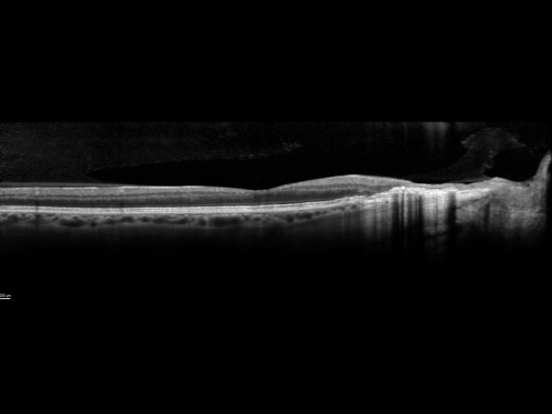 Ocular Histoplasmosis both Eyes - Laser Right Eye Only SD-OCT
58-year-old woman who lost vision as a child in the left eye from ocular histoplasmosis.  She used to play in her attic and she was told by her pulmonary doctor that is probably where she picked it up.  She had laser in the right eye for a leaky lesion back in 1990.  OD 20/25,  OS 20/200. 
