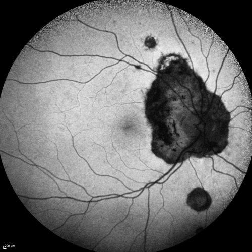 Ocular Histoplasmosis both Eyes - Laser Right Eye Only Fundus Autofluoresence
58-year-old woman who lost vision as a child in the left eye from ocular histoplasmosis.  She used to play in her attic and she was told by her pulmonary doctor that is probably where she picked it up.  She had laser in the right eye for a leaky lesion back in 1990.  OD 20/25,  OS 20/200. 

