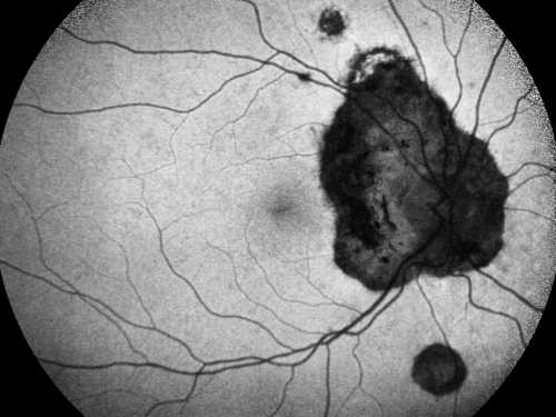 Ocular Histoplasmosis both Eyes - Laser Right Eye Only Fundus Autofluoresence
58-year-old woman who lost vision as a child in the left eye from ocular histoplasmosis.  She used to play in her attic and she was told by her pulmonary doctor that is probably where she picked it up.  She had laser in the right eye for a leaky lesion back in 1990.  OD 20/25,  OS 20/200. 
