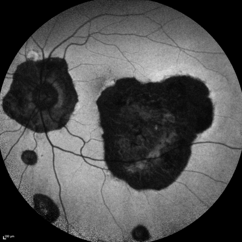 Ocular Histoplasmosis both Eyes - Laser Right Eye Only Fundus Autofluoresence
58-year-old woman who lost vision as a child in the left eye from ocular histoplasmosis.  She used to play in her attic and she was told by her pulmonary doctor that is probably where she picked it up.  She had laser in the right eye for a leaky lesion back in 1990.  OD 20/25,  OS 20/200. 
