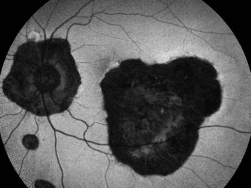 Ocular Histoplasmosis both Eyes - Laser Right Eye Only Fundus Autofluoresence
58-year-old woman who lost vision as a child in the left eye from ocular histoplasmosis.  She used to play in her attic and she was told by her pulmonary doctor that is probably where she picked it up.  She had laser in the right eye for a leaky lesion back in 1990.  OD 20/25,  OS 20/200. 
