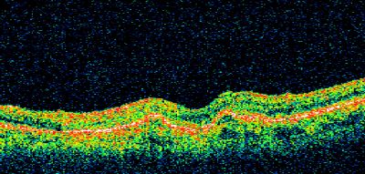 Wet AMD - Subfoveal CNVM - Excellent Response to Avastin
76-year-old woman two to three months of vision loss OD

Vision started at 20/200 and with Avastin improved to 20/25.  She has required monthly injections and as of October 2010 has been treated about 16 times.  Her left eye remains good at 20/20. 

The OCT from post-treatment as well as pretreatment images are in this album.
