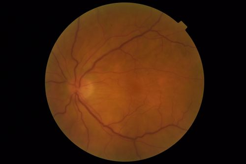 Posterior Scleritis - positive T-sign
62 year ols man was sick about 6 weeks ago and then 2 weeks ago the the left eye got red.  He was treated for conjunctivitis and the eye did not get better.  Topical steroids and oral non-steroidal anti-inflammatory medications did not help.  
VA OD: Dcc20/25 NccJ5
VA OS: Dcc5'/200 
The scleritis cleared within 2 weeks of starting high dose (80 mg) oral steroids.  Blood tests were all negative.
