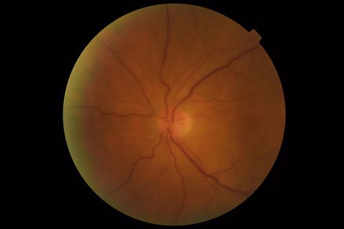 Posterior Scleritis - positive T-sign
62 year ols man was sick about 6 weeks ago and then 2 weeks ago the the left eye got red.  He was treated for conjunctivitis and the eye did not get better.  Topical steroids and oral non-steroidal anti-inflammatory medications did not help.  
VA OD: Dcc20/25 NccJ5
VA OS: Dcc5'/200 
The scleritis cleared within 2 weeks of starting high dose (80 mg) oral steroids.  Blood tests were all negative.
