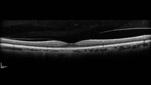 Posterior Scleritis - positive T-sign
62 year ols man was sick about 6 weeks ago and then 2 weeks ago the the left eye got red.  He was treated for conjunctivitis and the eye did not get better.  Topical steroids and oral non-steroidal anti-inflammatory medications did not help.  
VA OD: Dcc20/25 NccJ5
VA OS: Dcc5'/200 
The scleritis cleared within 2 weeks of starting high dose (80 mg) oral steroids.  Blood tests were all negative.
