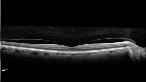 Posterior Scleritis - positive T-sign
62 year ols man was sick about 6 weeks ago and then 2 weeks ago the the left eye got red.  He was treated for conjunctivitis and the eye did not get better.  Topical steroids and oral non-steroidal anti-inflammatory medications did not help.  
VA OD: Dcc20/25 NccJ5
VA OS: Dcc5'/200 
The scleritis cleared within 2 weeks of starting high dose (80 mg) oral steroids.  Blood tests were all negative.
