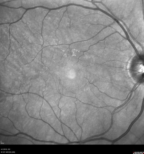 Posterior Scleritis - positive T-sign
62 year ols man was sick about 6 weeks ago and then 2 weeks ago the the left eye got red.  He was treated for conjunctivitis and the eye did not get better.  Topical steroids and oral non-steroidal anti-inflammatory medications did not help.  
VA OD: Dcc20/25 NccJ5
VA OS: Dcc5'/200 
The scleritis cleared within 2 weeks of starting high dose (80 mg) oral steroids.  Blood tests were all negative.
